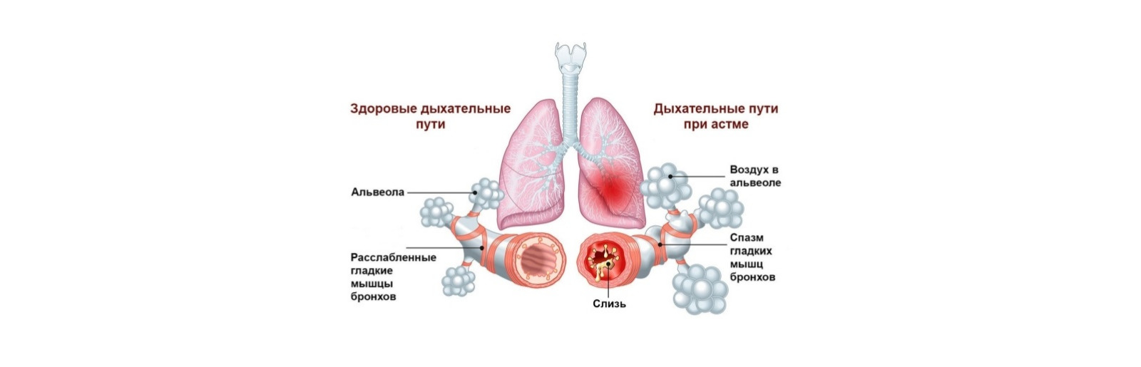 Бронхиальная астма